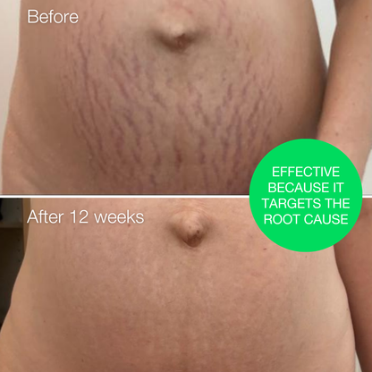 Redefining Stretch Mark Cream