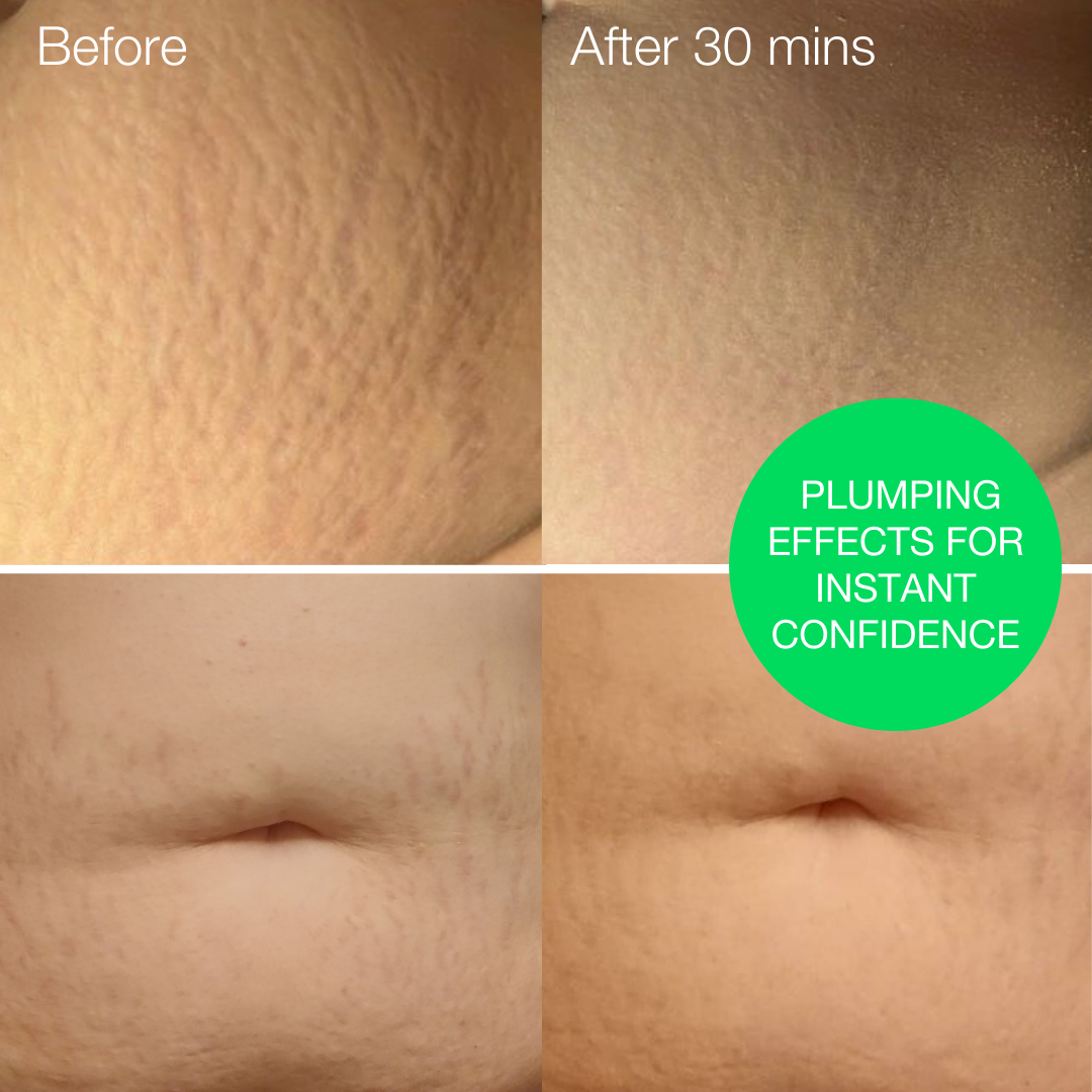 Redefining Stretch Mark Cream