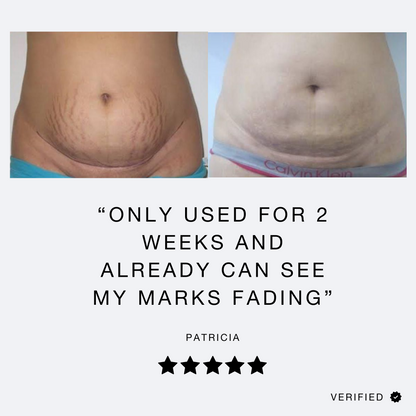 Redefining Stretch Mark Cream